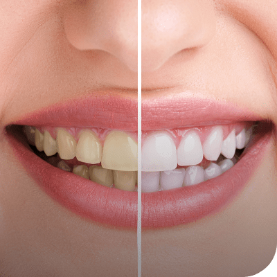 Teeth Whitening | Absolute Dentistry | Family & General Dentist | Okotoks Dentist