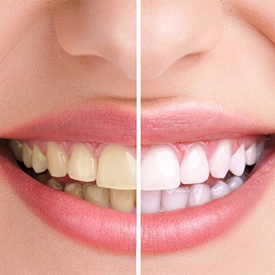Cosmetic Dentistry | Absolute Dentistry | Family & General Dentist | Okotoks Dentist