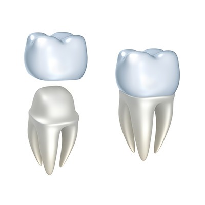 Dental Crowns | Absolute Dentistry | Family & General Dentist | Okotoks Dentist