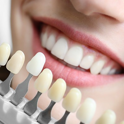 Porcelain Veneers | Absolute Dentistry | Family & General Dentist | Okotoks Dentist